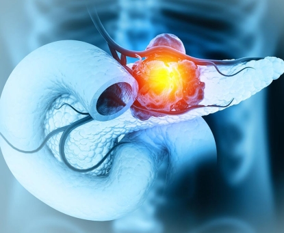 Hướng dẫn phòng ngừa ung thư tụy A-Z